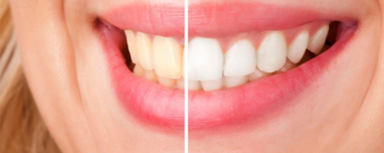 Professional Teeth Whitening